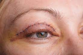 Eyelid Surgical procedure – Residing Gossip