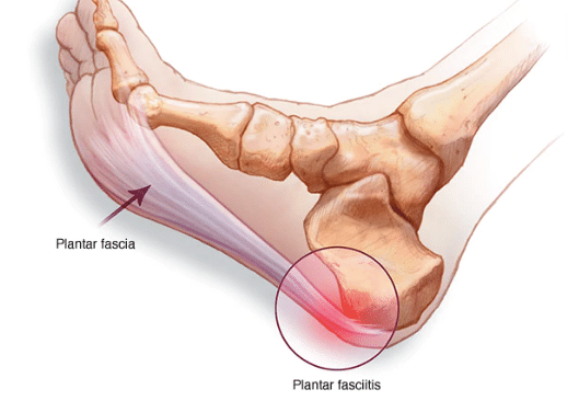 All the things You Have to Know About Plantar Fasciitis