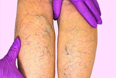 Power Venous Insufficiency – Causes and Remedy