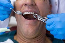 Four Reasons Your Dentist Will Recommend a Tooth Extraction