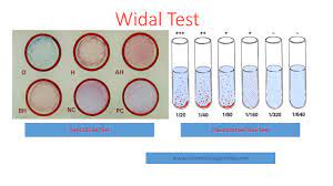 Widal Blood Test